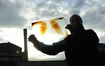 Un hombre muestra una radiografía de unos pulmones afectados por el amianto