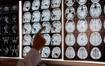 neurologia esclerosis multiple